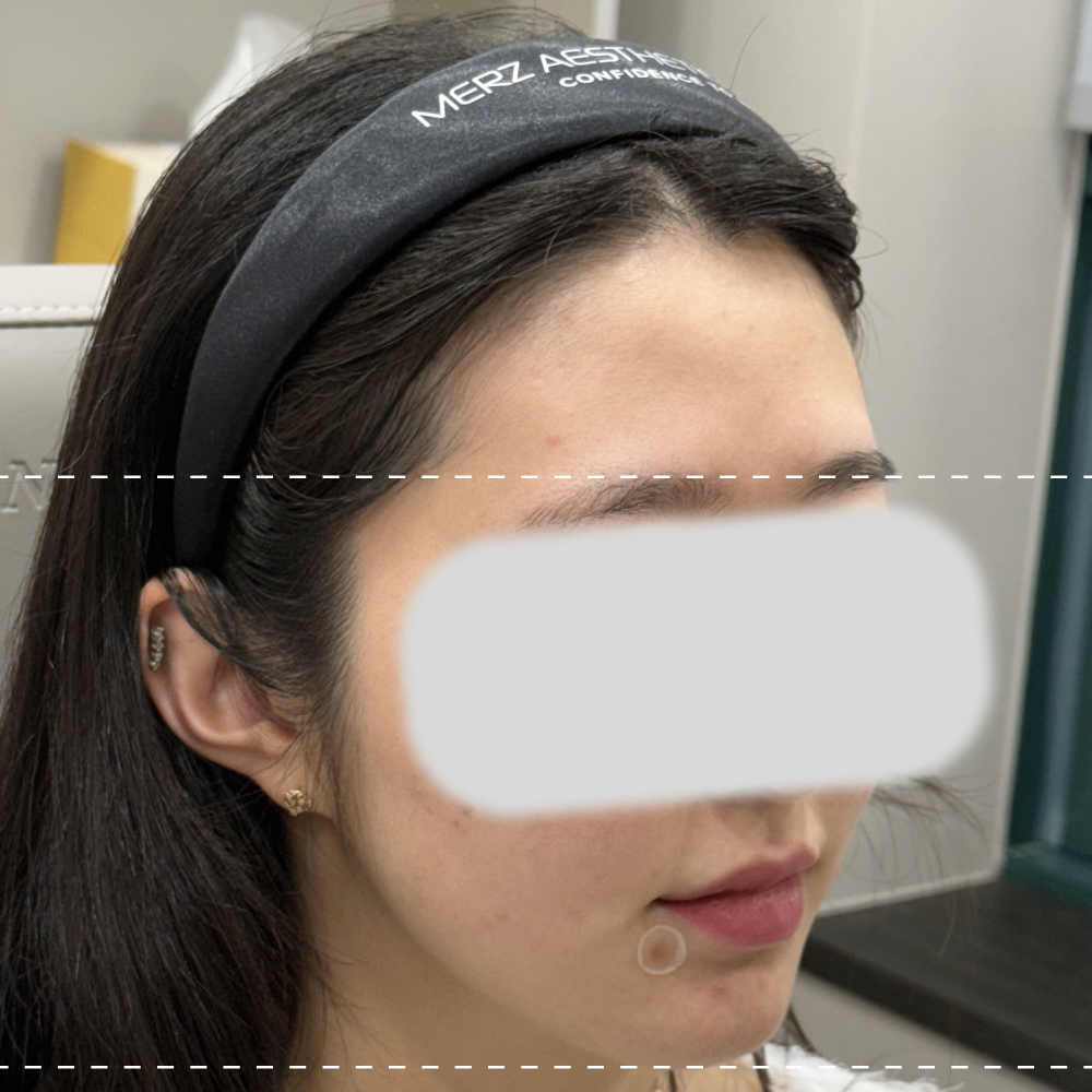 이마필러 오른쪽 45도 시술 전