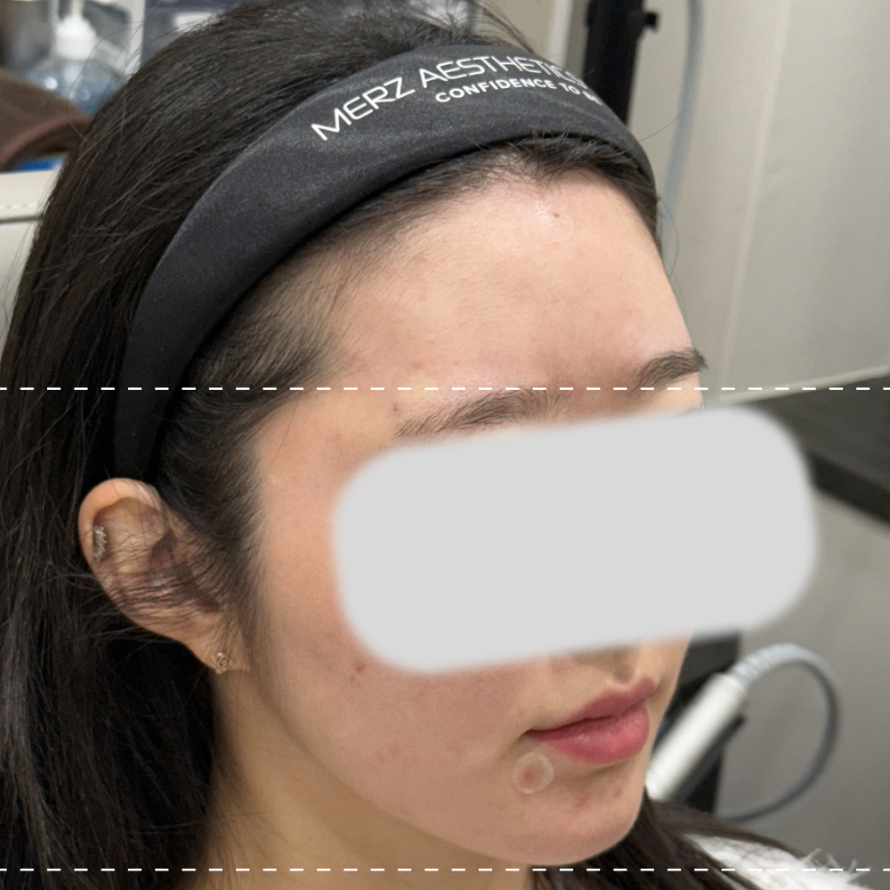 이마필러 오른쪽 45도 시술 후