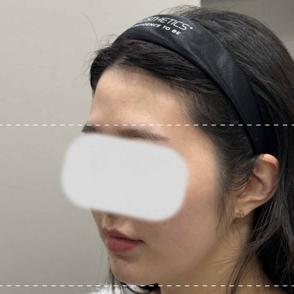 이마필러 왼쪽 45도 시술 전