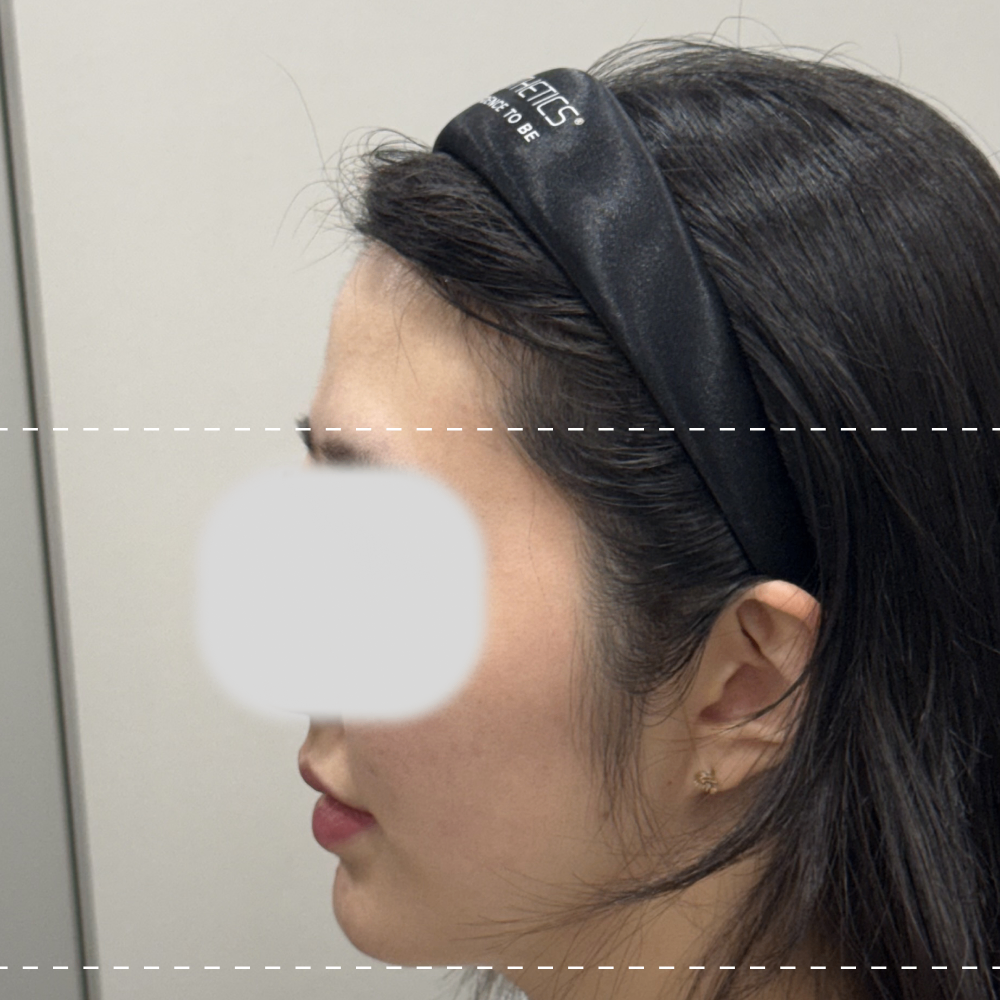 이마필러 왼쪽 90도 시술 전