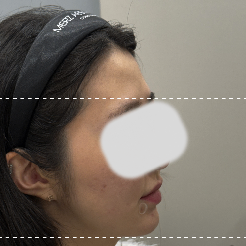 이마필러 오른쪽 90도 시술 전