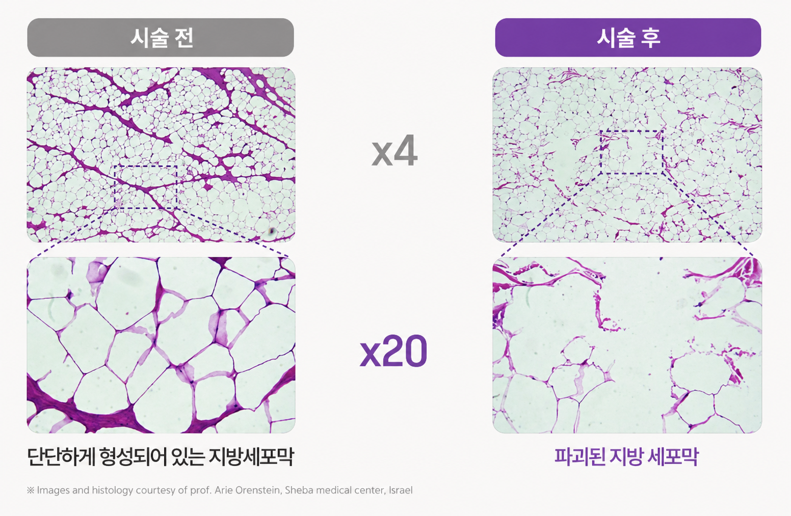 시술 전후 지방세포막 비교